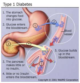 diabet-1